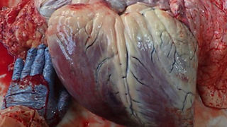Hématome de plus de 30 cm de diamètre sur un coeur de bovin avec une communication de 5 cm de diamètre entre les deux ventricules. Hématome de plus de 30 cm de diamètre sur un coeur de bovin avec une communication de 5 cm de diamètre entre les deux ventricules.
